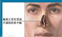 鼻中隔偏曲的原因有哪些 详解鼻中隔偏曲的三大原因